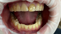 Реставрация фронтальной группы зубов винирами, 6 единиц, верхняя челюсть. Пациентка К. 33 года. До начала реставрации
