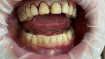 Реставрация фронтальной группы зубов винирами, 6 единиц, верхняя челюсть. Пациентка К., 33 года. В процессе лечения.
