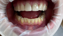 Реставрация фронтальной группы зубов винирами, верхняя челюсть. Пациентка К. 33 года. После реставрации